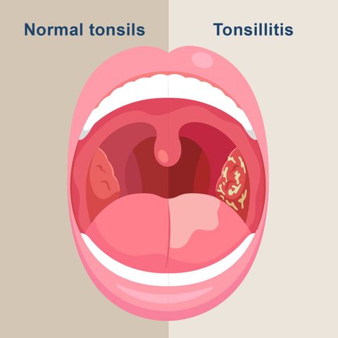 A Clear Overview of Tonsillitis Causes, Symptoms, and Treatment